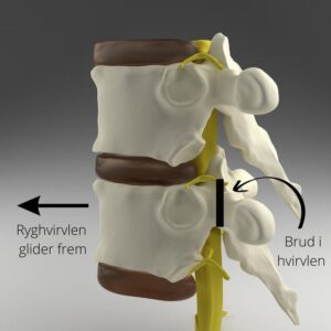 spondylolistese en ryghvirvlen glider frem