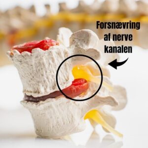 spinat stenose forsnævring af nervekanalen